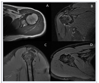 Figure 1 MRI images of the shoulder joint in patient 1 (A) –pseudocyst formation at the attachment of the greater tuberosity tendon of the  humerus. (B) –degeneration of the supraspinatus tendon and subscapularis muscle edema. (C-D) –a small amount of fluid accumulation around the  subacromial-subdeltoid bursa and the long head of the biceps tendon)