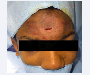 Surgical drainage through a frontal mini-incision.