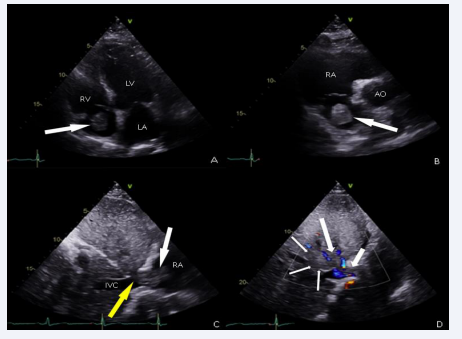 Two-dimensional transthoracic echocardiography. Apical four chamber view showing right atrium mass (white arrow) (A); Parasternal  short axis view reveals the mass independent from the tricuspid valve (white arrow) (B); Subcostal 4 chamber view shows mass extending through  the inferior vena cava (yellow arrow) in the right atrium (white arrow); (C) Color doppler in subcostal four chamber shows infiltration in the hepatic  veins (white arrows) (D)