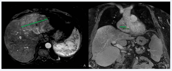 Upper abdomen MRI showing hepatocarcinoma of segment III of 10.5 cm (A); and cardiac metastasis in the right atrium (B)