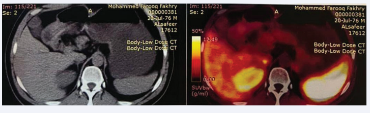 DOTA-NOC PET (Positron Emission Tomography) CT scan was performed during the year 2023 showing well distended stomach with  no evidence of radiotracer avid lesion.