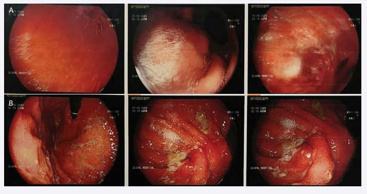  A: Gastroscopy performed on the first of August, 2023 showed moderate area of congestion and thickening at the proximal part of  the stomach with obvious suture line of previous surgery; B: Gastroscopy performed on the first of August, 2023 showed moderate area of  congestion and thickening at the proximal part of the stomach with obvious suture line of previous surgery