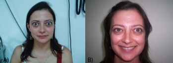Example of response to RT after failure of 2 cycles of intravenous corticosteroids at high dose. (a) August 2006 (before corticosteroid and RT), (b) August 2007 (6 months after RT).