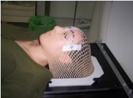 Thermoplastic shell with metallic marks over the laser reference points (laterals and nasion).