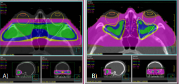 Examples of radiotherapy planning and dose distribution using external beam conventional 3D radiotherapy (using two lateral and opposed fields) (a) versus Volumetric modulate arch therapy (VMAT) (b) Observe the increase in conformation of the retrobulbar area of irradiation with VMAT.