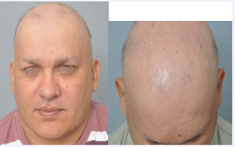 35-year-old male patient with Alopecia Areata Universalis - pre-treatment.