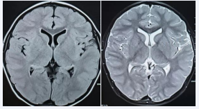 T1(left) and T2(right) weighted images of unenhanced crosssectional MRI of the child’s head.