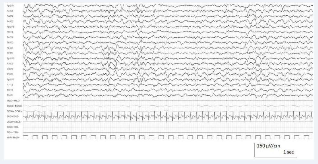 EEG pattern in NREM sleep. The pattern consisted of irregular slow waves predominantly over the left temporal region.