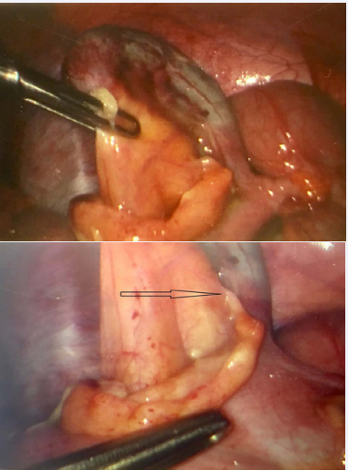 Prominent Treves fold with attachment to mesoappendix in an obese patient with complicated appendicitis. Limiting coagulation to the attachment (marked) ensures adequate blood supply to appendicular stump.