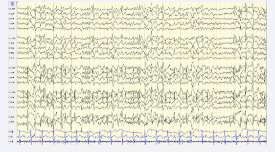 Throughout the EEG-registration occurred runs of 2,7- 3,1 Hz generalized spike-slow wave discharges usually with a duration of several seconds, partly the  generalized spike-wave activity is interrupted by short-lasting (usually about one second) high-frequent multiple spike activity. The patient suffered at times from flailing or shaking movements of the upper limbs especially in connection with the more continuous appearance of the above mentioned  spike-slow-wave activity and appeared drowsy and further showed at times twitching movements of the oral region.
