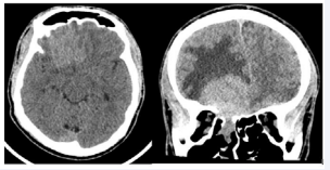 CT scan with axial and coronal slices of the brain showing a  hyperdense mass in right anterior cranial fossa with extension into the right  ethmoid. The mass measured 5.2 x 3.8 x 3.8 cm (AP, transverse, craniocaudal).  There is surrounding vasogenic edema present (R>L), with minimal lesional  extension across midline into the left mesial frontal lobe. Approximately 3mm  right-to-left shift is present at the level of the third ventricle