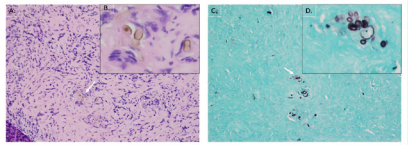 A) 20x H&E showing the Culvularia buds in association with giant cells. B) 40x view of the pigmented organisms with their characteristic bulbous morphology.  C) 20x GMS stain showing the Culvularia. D) 40x GMS stain showing classic grouping.