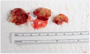 Intraoperative fungal specimen photographed here prior to being  packaged and sent to pathology. Internal debulking was done in a piecewise  fashion and select specimens from frontal lobe lesion are photographed here.