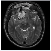 Post operative T2 MRI sequence taken four days after bifrontal  craniotomy and endonasal resection of right frontal abscess. No evidence of  residual macroscopic disease with improving right frontal edema