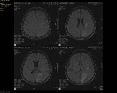 Figure 1 Magnetic resonance image of the brain, including an ischemic lesion of the right occipital lobe.