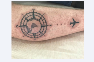 Figure 2 Fifteen days after, the patient progressed with improvement and complete lesion regression.