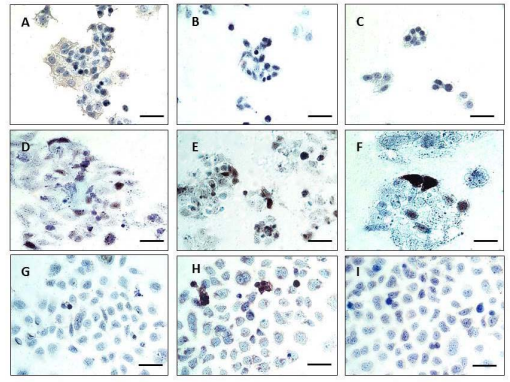 Panel A. Determination of specificity of antibodies to BRG1. The lung cancer-derived cell line H522, which expresses neither BRG1 nor BRM, shows no immunoreactivity for BRG1 using sc-374197 (A), sc-10768 (B) or 21634-1-AP (C). H522 cells transiently transfected with BRG1 show mosaic immunoreactivity for the BRG1 antibodies sc-374197 (D), sc-10768 (E) and 21634-1-AP (F). When H522 cells were transiently transfected with BRM, cells stained negative with sc-374197 (G) and with 21634-1-AP (I), but there were some immunoreactive cells with sc-10768 (H). All images are 63x. Scale bar=20µm.