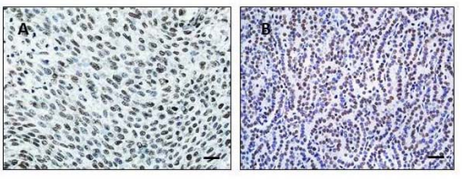Figure 3a Panel A: A human FFPE NSCLC specimen stained with our gold standard mouse monoclonal antibody (gift from Pierre Chambon) at a 1:100 dilution (A). A murine tumor stained with the same antibody at a 1:100 dilution (B). 40x magnification. Scale bar=20µm.
