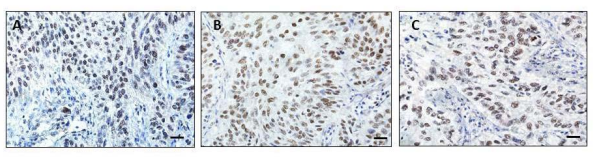 Panel B. High magnification (40x) of a human lung tumor stained with sc-374197 (A), LS-B5107 (B) and 21634-1-AP (C). Non
