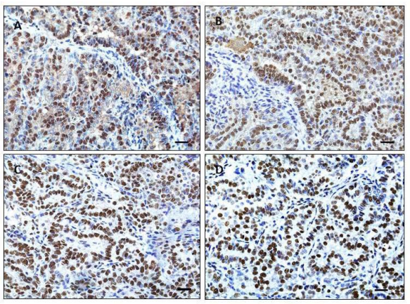 Panel C. A murine lung tumor at 40x magnification stained with sc-374197 (A), sc-10768 (B), LS-B5107 (C) and 21634-1-AP, pH6 (D).As in Panel A, nonspecific background staining is observed in (A), since this was a mouse antibody applied to mouse tissue. The goal polyclonal antibody from LifeSpan Biosciences and the rabbit polyclonal antibody from PT give crisp, clear staining in tissues derived from both mouse and human. All images at 40x magnification. Scale bar=20µm.
