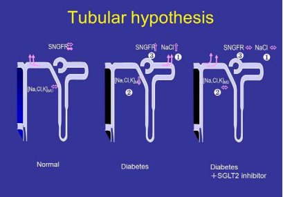 Compared to normal condition (left), ultrafiltrate in Bowman capsule contains significant amount of glucose in diabetes (middle). Because  proximal tubules reabsorb more sodium with glucose through sodium glucoseco-transporter (SGLT) in diabetes [1], the delivery to macula densa  is decreased [2]. This weakens tubuloglomerular feedback (TGF) signals to increase glomerular filtration rate [3], accounting for hyperfiltration in  early stage of diabetes. SGLT inhibition (right] inhibits proximal tubular reabsorption [1], restoring sodium chloride delivery to macula densa even  under hyperglycemic condition [2]. This would have TGF work and normalize glomerular filtration rate [3], ameliorating glomerular hyperfiltration.