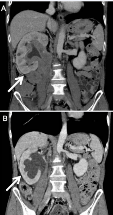 Figure 1 A) Abdominal computed tomography at admission. The  tumor invaded the right renal hilus, and the right kidney was  swollen (arrow). B): Abdominal computed tomography after  chemotherapy. The tumor reduced in size, but the hydronephrosis  remained (arrow).