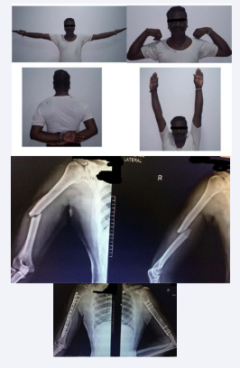 Case 1 Pre-op and Post op X-Ray with good union and full range of motion.