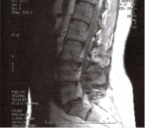 This MRI revealed a herniated disk between L3 and L4 and a bulging  disk between L5 and S1.