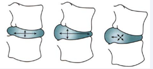 Representation of a herniated disk and how it moves according to the  weight-bearing forces placed upon it