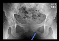 Follow up x-ray examination shows full cortical healing of the pubic bone after 6 months.