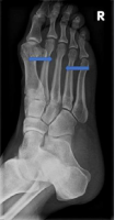 The 2 arrows show the cortical deficit with a cloudy appearance at the distal 3. Metatarsal bone typical of a stress fracture.