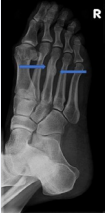 Follow up x-ray examination shows full bone healing with solid callus formation at the lesion site following 3 months of treatment.