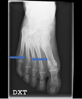 The arrows point to the nonunion/stress fracture of the distal 4. Metatarsal bone.