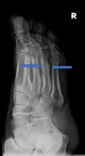 The arrows point to full bone healing with callus formation on x-ray follow up after 3 months of the 4. Metatarsal.
