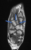 Initial transverse view on MR-examination shows as the previous figure 10. fracture in the intermediate and lateral cuneiform bones with a free bone fragment and increased joint widening.