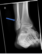 Initial x-ray examination after casting for 7 weeks shows nonunion of the distal fibula