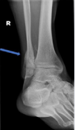 Follow up x-ray shows full bone healing at the previous fracture site with good callus formation
