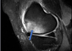 Initial MR-examination showed a large bone bruise located at the medial femoral condyle.