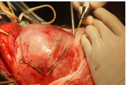 Osteotomy with use of the piezoelectric surgical devices  (Piezosurgery®- MECTRON, Italy).