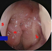 Nasopharynx seen through the Left nasal cavity a. Adenoid tissue, b. Eustachian tube opening, s. Nasal septum