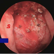 Complete adenoid tissue removal and haemostasis achieved, s. Nasal  Septum.