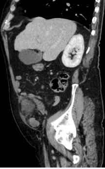Right Spigelian hernia containing small bowel loop in sagittal view of CT scan.