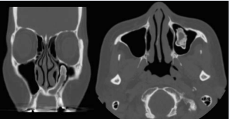 CT images at the time of presentation. A. Coronal view. B. Axial view.  The tumor is pedunculated and its base is located at the inferomedial angle  of the maxillary sinus. The inside of the tumor seems to be encapsulated by  maxillary sinus mucosa.