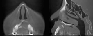 CT images two weeks before the second surgery. A. Coronal view. B.  Sagittal view. The anterior wall of the alveolar ridge is destructed partially. The  hard palate is also erosive.