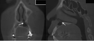 CT images one year after the second surgery. A. Coronal view. B.  Sagittal view. The opened window had disappeared. Puncture of the nasal floor  confirmed that this was not due to the occlusion of the cyst window but to the  proliferation of the surrounding soft tissue.