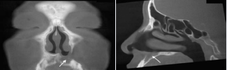 CT images one year after the second surgery. A. Coronal view. B.  Sagittal view. The opened window had disappeared. Puncture of the nasal floor  confirmed that this was not due to the occlusion of the cyst window but to the  proliferation of the surrounding soft tissue.