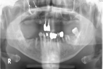 Panoramic photograph taken at the referring dental clinic. A bony  mass is seen in the right maxillary sinus (arrows).