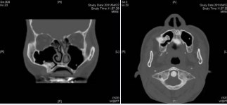 CT images at the time of the patient’s presentation to the senior  author’s clinic. A. Coronal view. B. Axial view. A cauliflower-like, osseous tumor  is seen. Its base is wide and located at the lower lateral wall of the right maxillary  sinus in the vicinity of the alveolar ridge