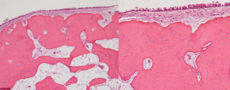 Photograph showing dense bone (H&E). A. Low magnification. B.  High magnification. The surface of the tumor is covered with mucosa and  submucosal tissue