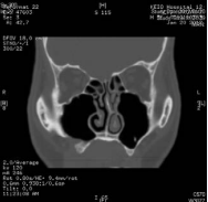 CT images 6 weeks after irrigation of the maxillary sinus